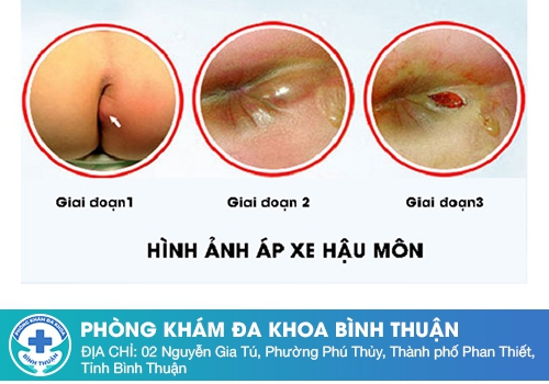  Biến chứng của áp xe hậu môn