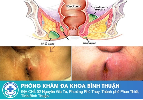 Dấu hiệu nhận biết nhanh áp xe hậu môn