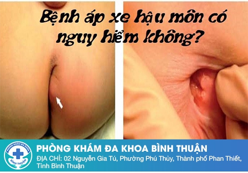 Áp xe hậu môn nguy hiểm như thế nào?