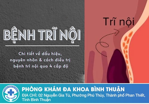 Tổng quan về bệnh trĩ nội