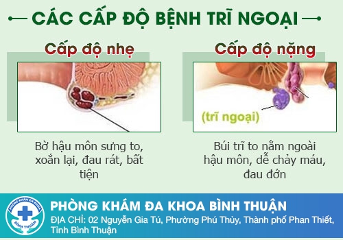 Dấu hiệu nhận biết trĩ ngoại là gì?