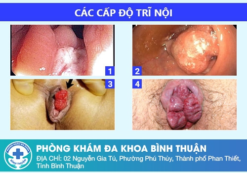 Bệnh trĩ nội có nguy hiểm không?