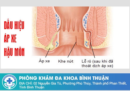 ​   Những triệu chứng thường gặp của áp xe hậu môn