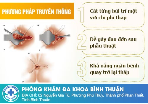 Thắt trĩ truyền thống