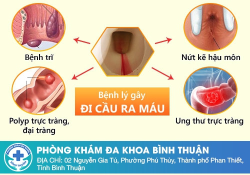 Nguyên nhân đi cầu ra máu nhiều là gì?