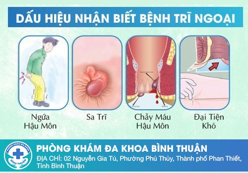 Các dấu hiệu dễ nhận biết sa búi trĩ sau sinh