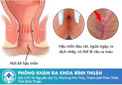 Triệu chứng của bệnh nứt kẽ hậu môn