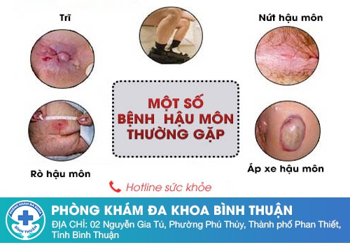 Các bệnh lý hậu môn trực tràng thường gặp