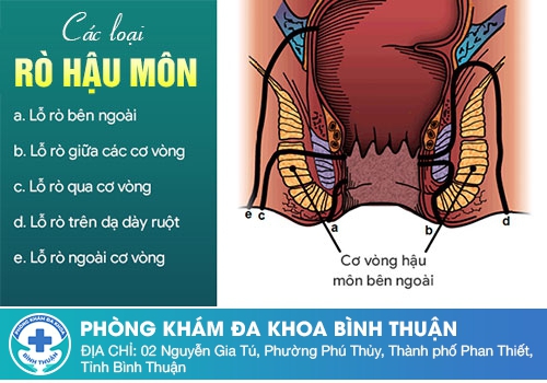 Nguyên nhân dẫn đến bệnh rò hậu môn