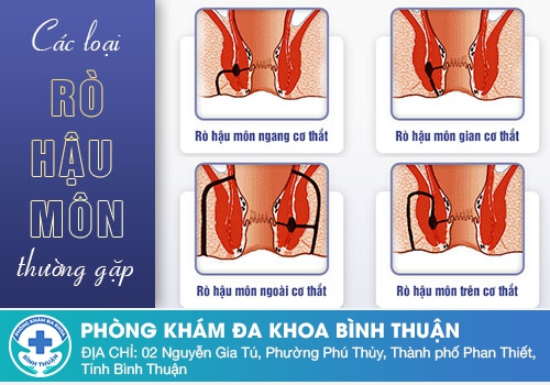 Phẫu thuật rò hậu môn hết bao nhiêu tiền?