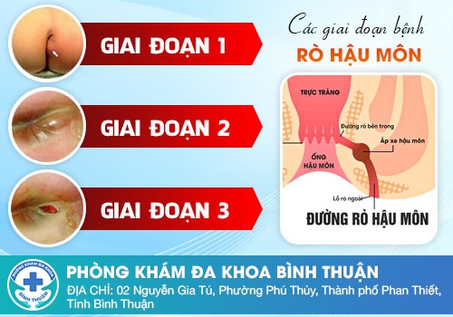 Nguyên nhân áp xe hậu môn là gì?