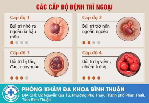 Các dấu hiệu dễ nhận biết sa búi trĩ sau sinh