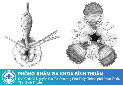 Cách trị sa búi trĩ hiệu quả, an toàn cao