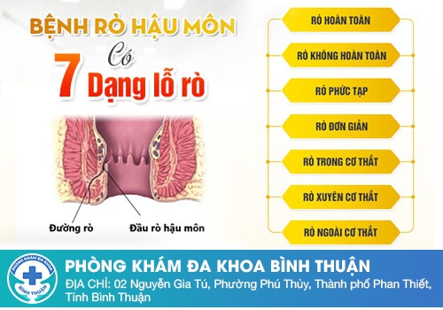 Rò hậu môn là gì? Nguyên nhân gây bệnh