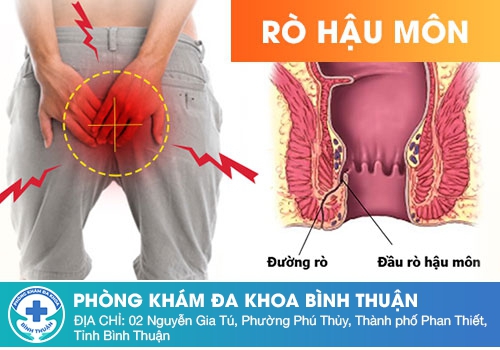 Nguyên nhân rò hậu môn 