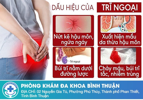 Sa búi trĩ có triệu chứng như thế nào?