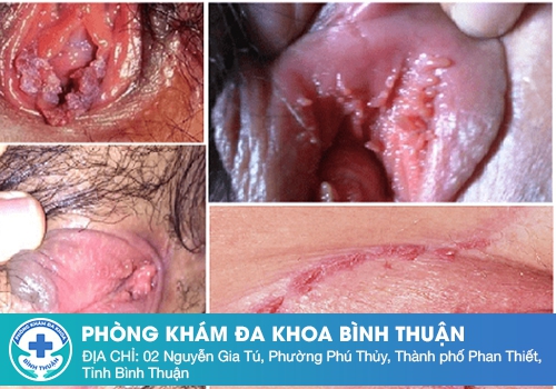 Thuốc bôi sùi mào gà có điều trị dứt điểm được không?