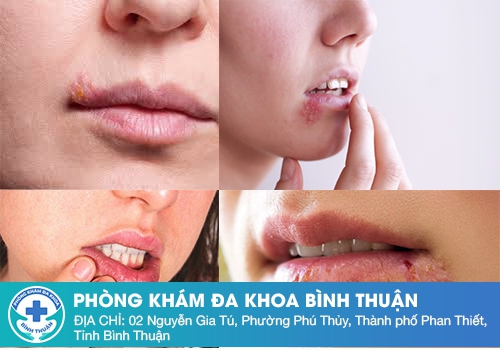 Mụn Herpes ở môi - miệng là gì?