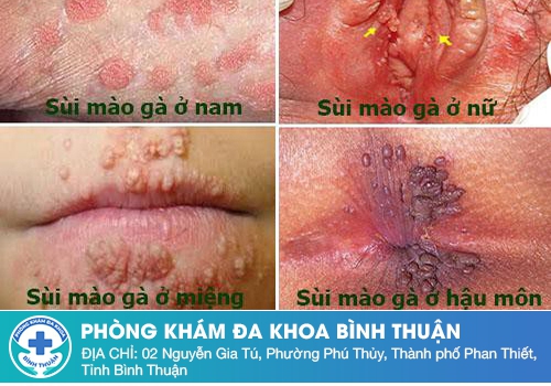 Giai đoạn phát triển của bệnh sùi mào gà