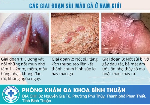 Dấu hiệu bệnh sùi mào gà ở nam giới