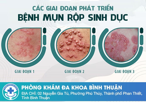 Nguyên nhân gây mụn Herpes ở miệng, môi