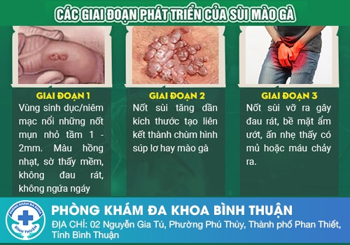 Giai đoạn phát triển của bệnh sùi mào gà