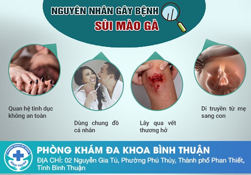 Nguyên nhân gây bệnh sùi mào gà ở nam giới