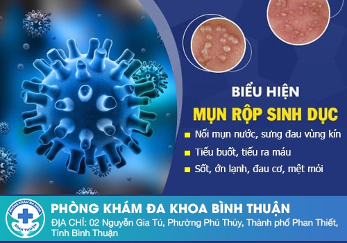 Triệu chứng mụn herpes môi