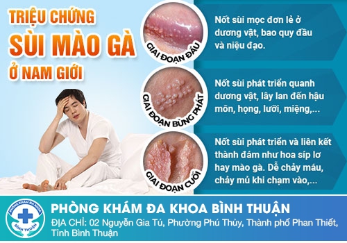 Triệu chứng, dấu hiệu bệnh sùi mào gà ở nam