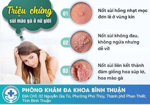 Dấu hiệu sùi mào gà như thế nào?