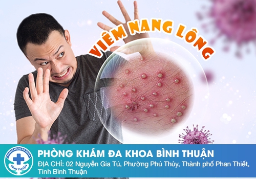 Nổi thịt thừa cửa mình do bệnh viêm nang lông