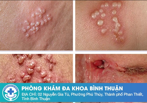 Có điều trị Virus Herps dứt điểm được không?