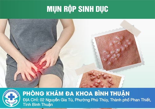 Nổi thịt thừa cửa mình do bệnh mụn rộp sinh dục