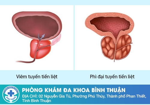 Tiểu buốt ở nam giới do phì đại tuyến tiền liệt