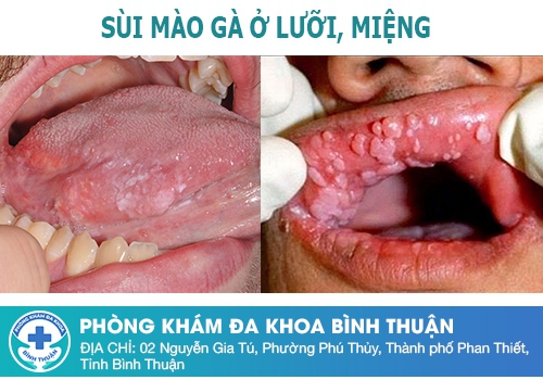 Sùi mào gà ở lưỡi có biểu hiện như thế nào?