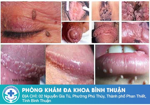 Tổng quan bệnh sùi mào gà ở nam giới