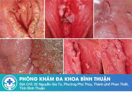 Xuất hiện thịt thừa vùng kín do sùi mào gà