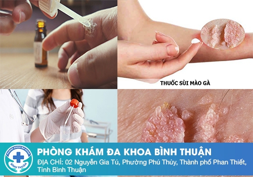 Cách chữa sùi mào gà hiệu quả