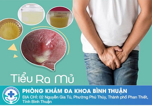 Hiện tượng tiểu buốt có mủ ở nam giới