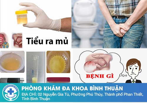 Tiểu buốt ra mủ có nguy hiểm không?