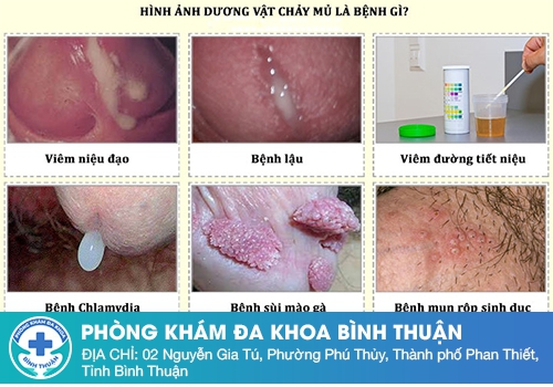 Tiểu buốt chảy mủ là bệnh gì?