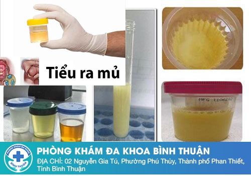 Nam giới tiểu buốt ra mủ là bệnh gì?