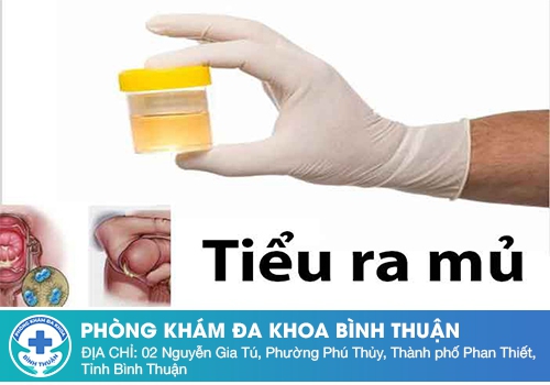 Tiểu buốt ra mủ là gì?