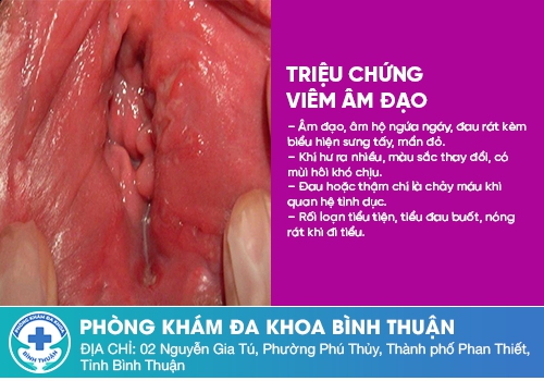 Xuất hiện thịt thừa vùng kín do viêm âm đạo