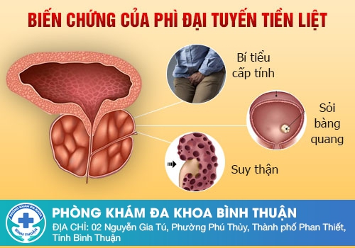 Phì đại tuyến tiền liệt có nguy hiểm không?