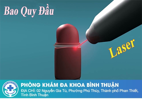 Phương pháp cắt bao quy đầu bằng tia laser