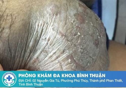 Bệnh chàm bìu có nguy hiểm không?