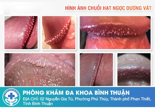 Hạt ngọc sinh dục có nguy hiểm không?