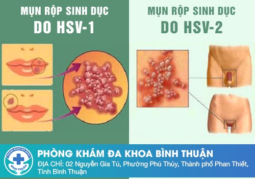 Ngứa bộ phận sinh dục nam là bị gì?