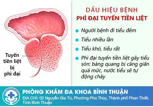 Triệu chứng phì đại tuyền tiền liệt như thế nào?